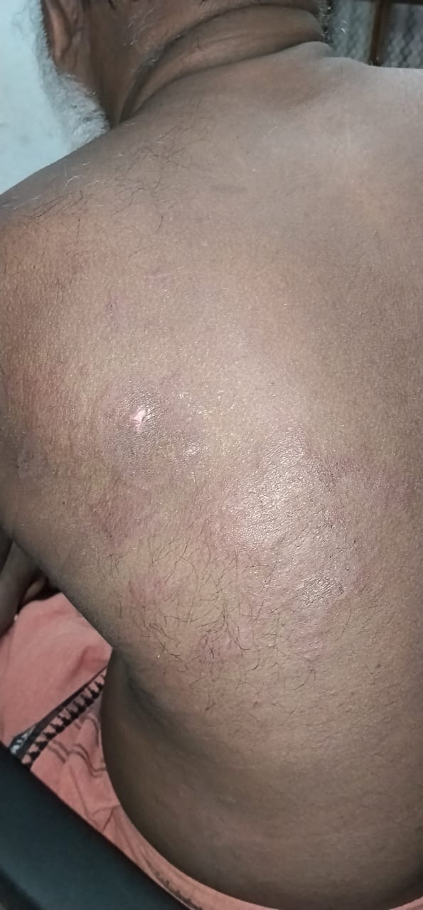 *പുറത്തിറങ്ങുമ്പോൾ ജാഗ്രത വേണം, പാനൂരിൽ ഓട്ടോ ഡ്രൈവർക്ക് സൂര്യാഘാതം*